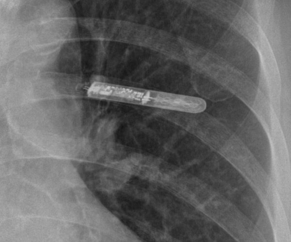 Loop Recorder Implantation - Doral Health & Wellness NY