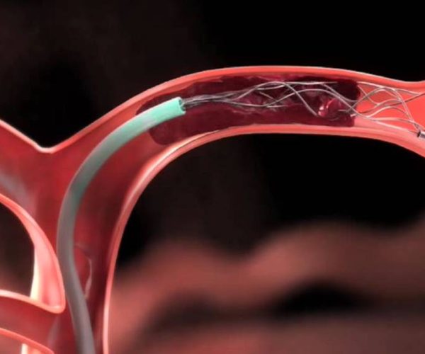 Embolization - Doral Health & Wellness NY